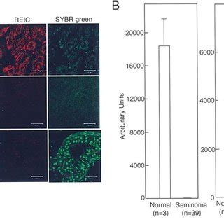 Expression Of REIC Dkk 3 In Human Seminoma And Non Seminoma Tissues