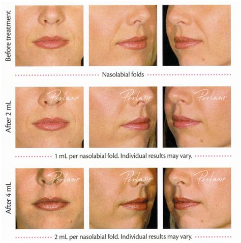 Before And After Restylane And Perlane Restylane Dermal Fillers