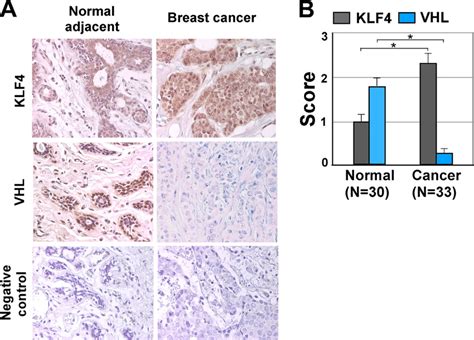 Regulation Of Klf4 By Vhl Is Validated In Human Breast Cancer Tissue A