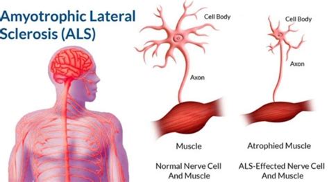 Amyotrophic Lateral Sclerosis Als Alimran Medical Center