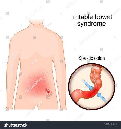 Irritable Bowel Syndrome Ibs Mucous Colitis Stock Vector (Royalty Free ...