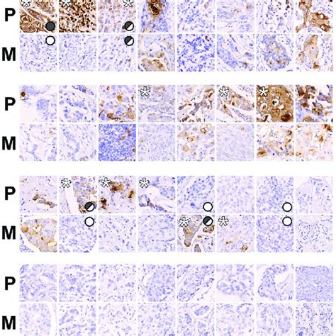 PDF Heterogeneity Of CEACAM5 In Breast Cancer