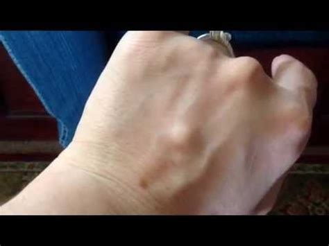 What is this Hard Lump on my hand? Ganglion Cyst #1 - YouTube