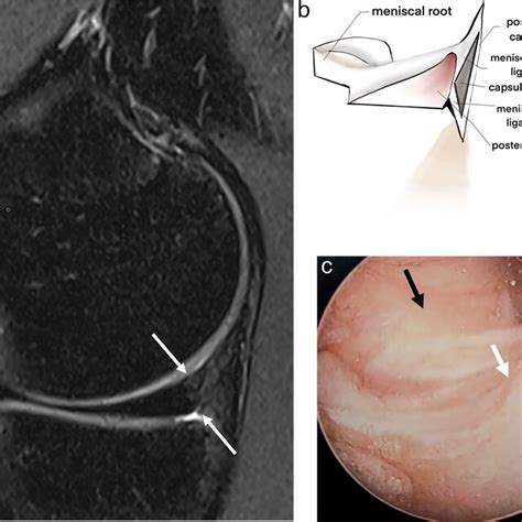 Normal Anatomy Of Posterior Horn Of The Medial Meniscus Red Zone And