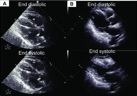 Transthoracic Echocardiography In The Left Parasternal Long Axis View