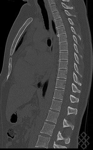 Scanner du Rachis dorsal Définition Déroulement Prise de rdv en ligne