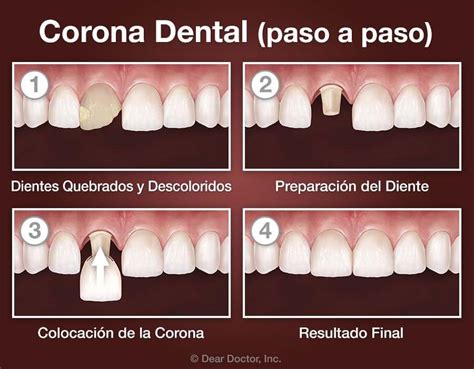 Corona Dental Qu Es Y Cu Ndo Es Necesaria