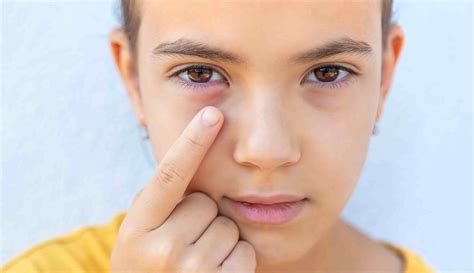 Conjuntivitis En Niños Síntomas Y Cómo Tratarla