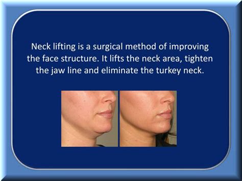 PPT - Why Choose Neck Lift for Turkey Neck PowerPoint Presentation - ID:7403258