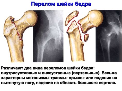 Повреждения таза, проксимального отдела бедренной кости - презентация ...