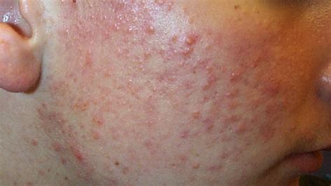 Raised Skin Bumps Pictures Types Causes And Treatment