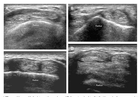 The Intersection Syndrome Ultrasound Findings And Their Diagnostic