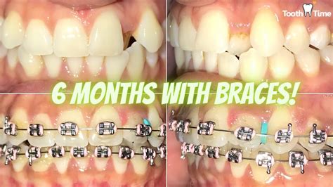 Month Braces