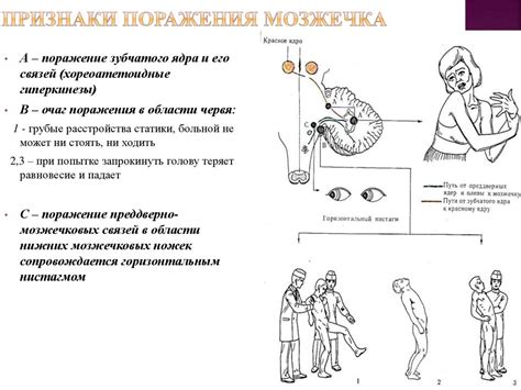 Мозжечок, синдромы поражения. Экстрапирамидная система, синдромы ...