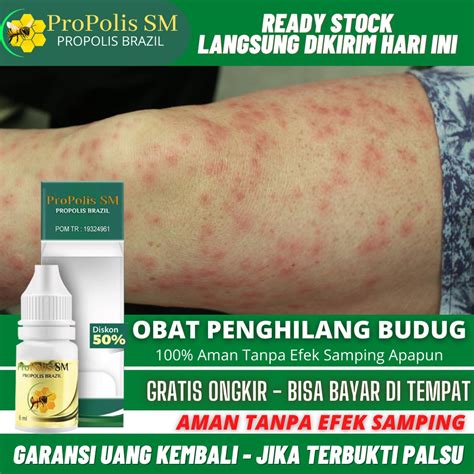 Jual Obat Gatal Scabies Manusia Penghilang Bekas Budug Gatal Akibat