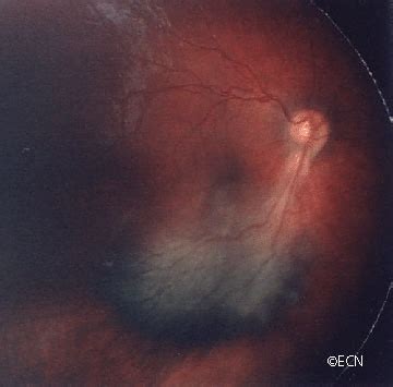 Retinal Tumors New York Eye Cancer Center