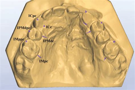 Nitial And Final Digital Models Showing The Results Of Rapid Maxillary