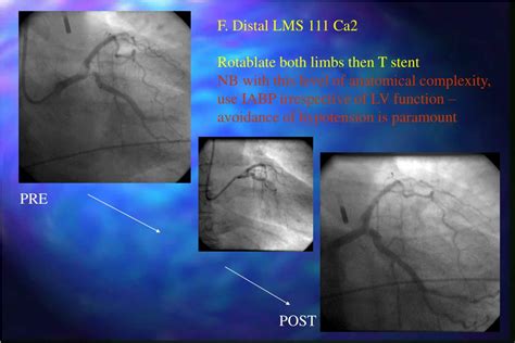 PPT When How I Use Rotational Atherectomy For Unprotected Left Main