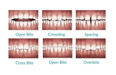 Invisalign Most Asked Questions Bromsgrove