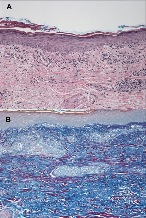 Drug Induced Subacute Cutaneous Lupus Erythematosus Associated With