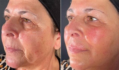 How To Look Younger 60 Year Old Feels Alive Again After Facial