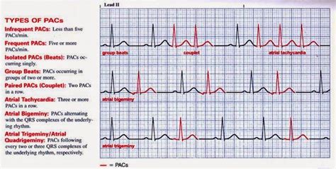 Premature Atrial Contraction Atrial Ekstrasistol Ina Ecg