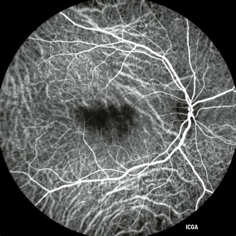 Heidelberg Spectralis Widefield Imaging Module Innova