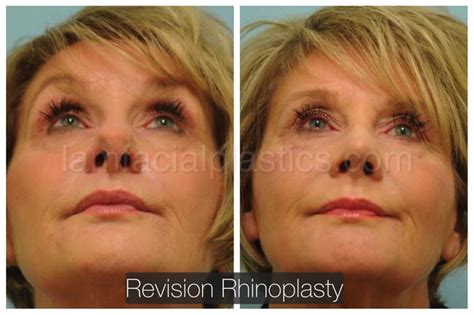 Rhinoplasty Dallas Nose Job Plano Nose Surgery Doctor