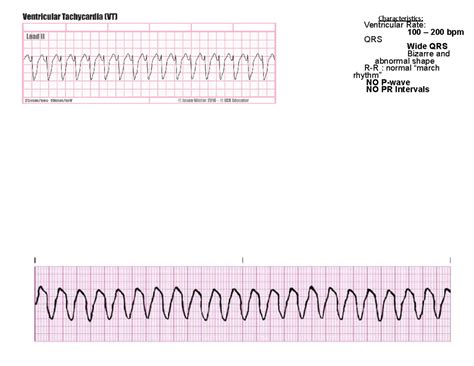 lethal rhythms characteristics ventricular rate   bpm qrs