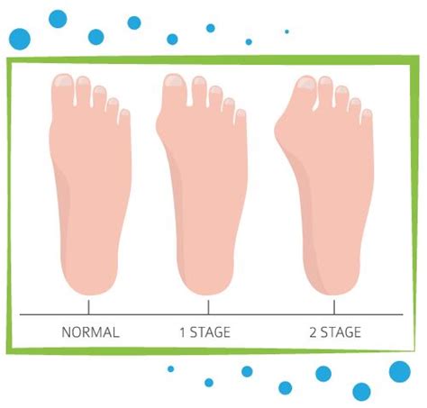 Chirurgie Hallux Valgus Tunisie Pour Cachez L Oignon Du Pied