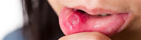 Oral Thrush Lips