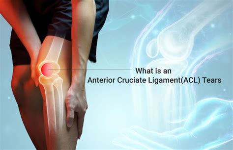 What Is An Anterior Cruciate Ligamentacl Tears