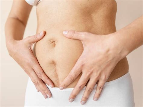 What To Expect After A C Section Delivery This Is What A Doctor Says