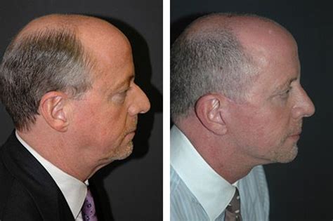 New York Rhinoplasty Specialist Dr Andrew Jacono Male Rhinoplasty