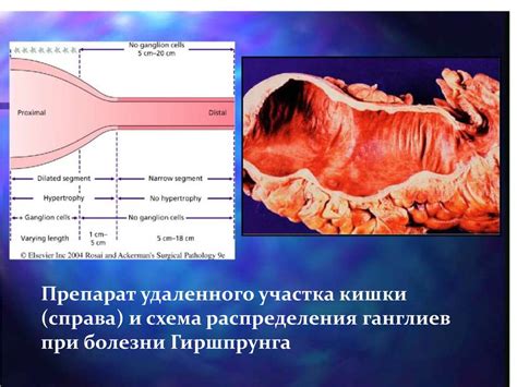 Болезнь Гиршпрунга - online presentation