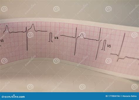 Electrocardiogram Strip With Heartbeat Represented On Paper Graph