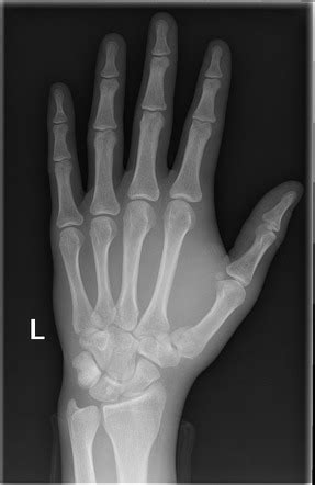 Bennett Fracture Radiology Case Radiopaedia Org