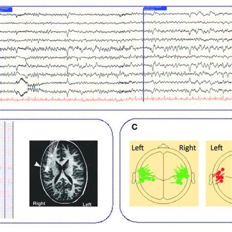 Typical Ictal Aspect On Standard Eeg In Ects And Electrical Source