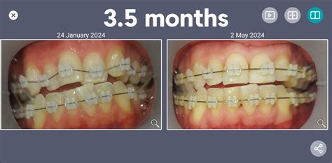 3 Month Update R Braces