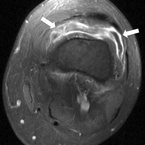 Isolated suprapatellar bursitis | Eurorad