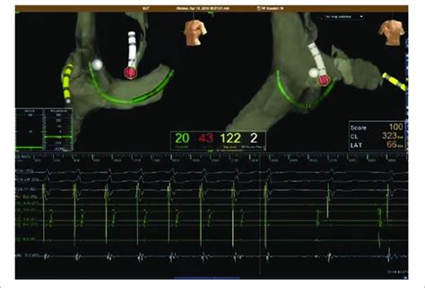 Representative Electroanatomical Map During Ablation Of Left Sided