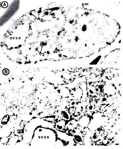 Figure 1 From Gray Platelet Syndrome Immunoelectron Microscopic