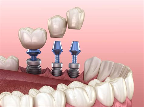 Curiosities About Implant Treatment Dentevim Dental Clinic