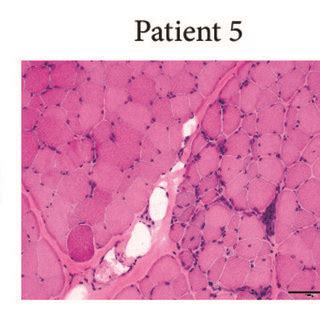 Pathologic Changes In Muscle In Patients With Limb Girdle Muscular