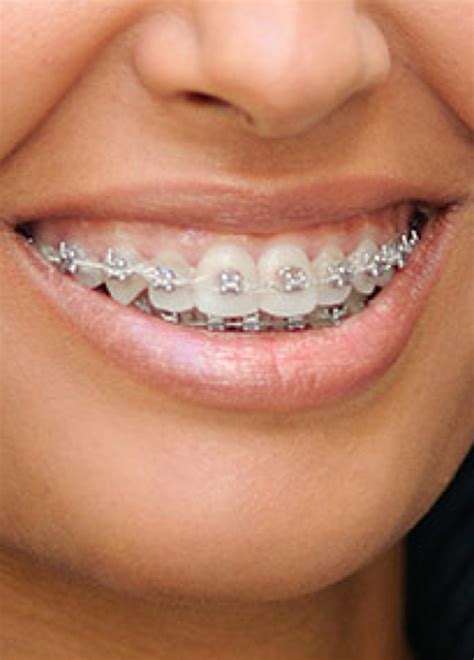 Orthodontist Atlanta Ga Marietta Ga Orthodontist