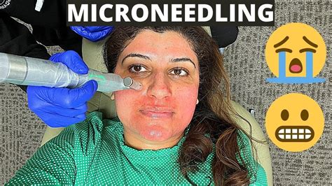 My Microneedling Experience And What To Expect Skin Updates Before