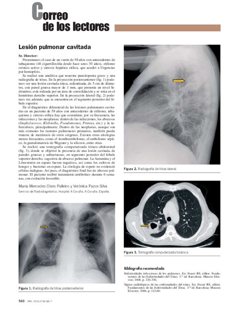 Pdf Lesión Pulmonar Cavitada Veronica Silva