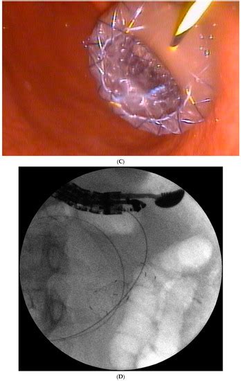 JCM Free Full Text The Role Of Endoscopic Transpapillary Stenting