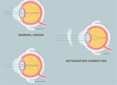 Understanding 025 Astigmatism Causes Symptoms And Treatment