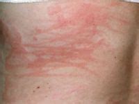 14 Dermatographia Urticaria Causes ideas | urticaria, skin, treatment